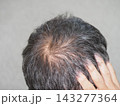 抜け毛・薄毛に悩む男性④ 143277364
