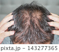 抜け毛・薄毛に悩む男性⑤ 143277365