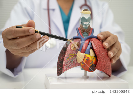 Pneumonia, lung cancer, Asian doctor holding human anatomy model for study diagnosis and treatment in hospital. Pneumonia, lung cancer, Asian doctor holding human anatomy model for study diagnosis and treatment in hospital. 143300848