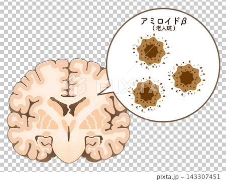 The brain of someone with Alzheimer's disease: Amyloid-beta and tau protein The brain of someone with Alzheimer's disease: Amyloid-beta and tau protein 143307451