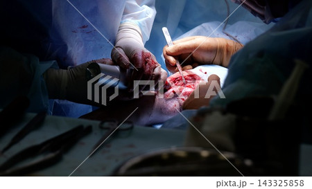 Surgeons working meticulously during a complex operation, using specialized instruments and advanced techniques to address a critical medical condition and save a patient's life 143325858
