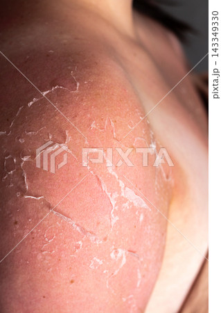 Woman with peeling skin on shoulders after sunburn. Red irritated patches from UV overexposure. Reminder to apply SPF cream and avoid peak sun hours for safety Woman with peeling skin on shoulders after sunburn. Red irritated patches from UV overexposure. Reminder to apply SPF cream and avoid peak sun hours for safety 143349330