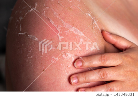 Close up of peeling skin on woman arms after sunburn. Redness and flaking indicate UV burn. Result of ignoring using SPF cream and safe sun exposure hours 143349331