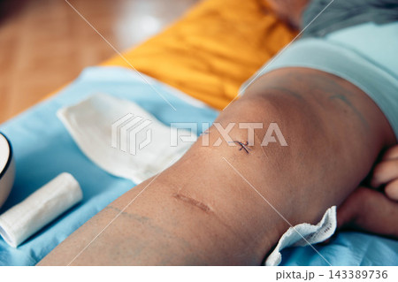 close up of healing knee after orthopedic surgery with fresh stitches and surgical scar during home recovery on a bed with medical bandages and dressing supplies concept of healthcare orthopedic 143389736