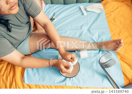 plus size young woman performing home wound care for a bruised and injured leg while sitting on a bed with gauze pads, bandages, and a crutch nearby, illustrating recovery, first aid, and 143389740