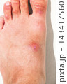 inflamed wound with a bacterial infection caused by an insect bite on foot. A red abscess with pus on the skin of the leg closeup 143417560