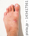 inflamed wound with a bacterial infection caused by an insect bite on human foot. A red abscess with pus on the skin 143417561