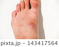 inflamed wound with a bacterial infection caused by an insect bite on a human foot. A red abscess with pus on skin of the leg close up 143417564