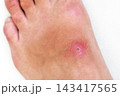 red pustular wound with a bacterial infection on a human leg closeup. Inflamed insect bite on the skin against a white background 143417565