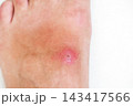 pustular wound with a bacterial infection on a human leg closeup. Red inflamed insect bite on the skin against a white background 143417566