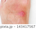 pustular wound with a bacterial infection on a human leg close up. Red inflamed insect bite on the skin on a white background 143417567