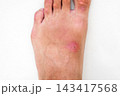inflamed wound with a bacterial infection caused by an insect bite on a human foot. A red abscess with pus on skin of the leg close up on the white background 143417568