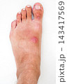 pustular wound with a bacterial infection on a human leg. Red inflamed insect bite on the skin 143417569