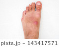 inflamed wound with a bacterial infection caused by an insect bite on a human foot. A red abscess with pus on the skin 143417571