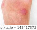 pustular wound with a bacterial infection on human leg close up. Red inflamed insect bite on the skin against a white background 143417572