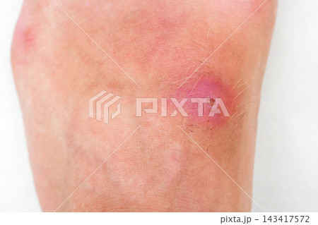 pustular wound with a bacterial infection on human leg close up. Red inflamed insect bite on the skin against a white background pustular wound with a bacterial infection on human leg close up. Red inflamed insect bite on the skin against a white background 143417572