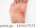inflamed wound with a bacterial infection caused by an insect bite on a human foot. A red abscess with pus on the skin of leg closeup 143417573