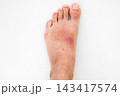 inflamed wound with a bacterial infection caused by an insect bite on human foot. A red abscess with pus on skin of the leg on the white background 143417574