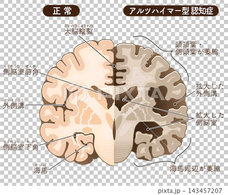 The brain of an Alzheimer's patient The brain of an Alzheimer's patient 143457207