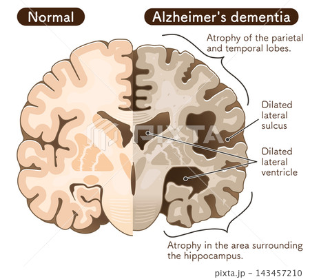 アルツハイマー病患者の大脳 The brain of an Alzheimer's patient アルツハイマー病患者の大脳 The brain of an Alzheimer's patient 143457210