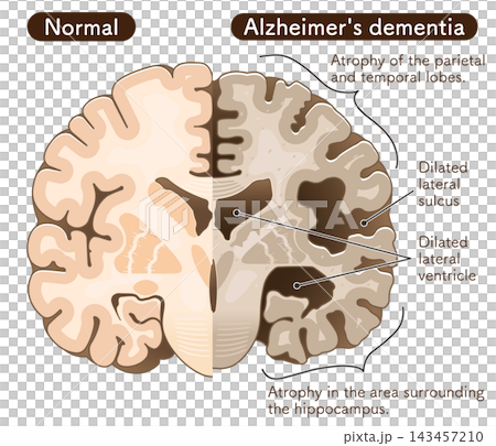 アルツハイマー病患者の大脳 The brain of an Alzheimer's patient アルツハイマー病患者の大脳 The brain of an Alzheimer's patient 143457210