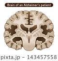 アルツハイマー病患者の大脳 The brain of an Alzheimer's patient 143457558