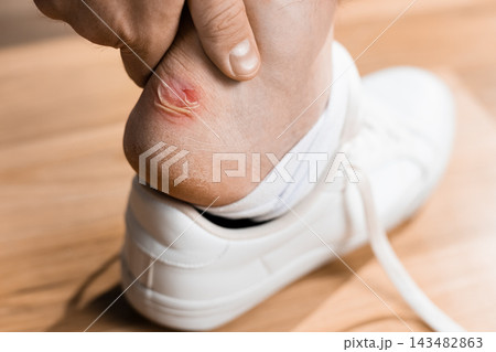 Man checking a painful blister on his heel caused by footwear friction. Close-up of sore foot, skin irritation, chafing wound, and shoe discomfort requiring medical first aid care. 143482863