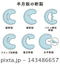 ひざ関節の半月板の断裂 Knee meniscus tear 143486657