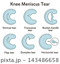 ひざ関節の半月板の断裂 Knee meniscus tear 143486658