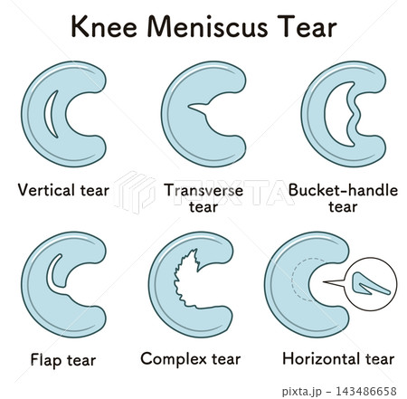 ひざ関節の半月板の断裂 Knee meniscus tear ひざ関節の半月板の断裂 Knee meniscus tear 143486658