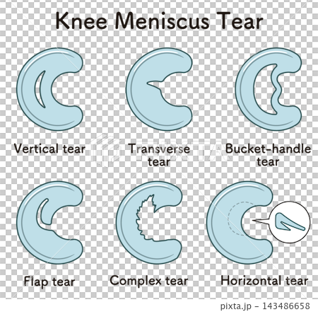 ひざ関節の半月板の断裂 Knee meniscus tear ひざ関節の半月板の断裂 Knee meniscus tear 143486658