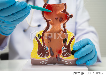Asian doctor with rectum and hemorrhoid human anatomy model at hospital, inflamed vascular structure. Asian doctor with rectum and hemorrhoid human anatomy model at hospital, inflamed vascular structure. 143490917