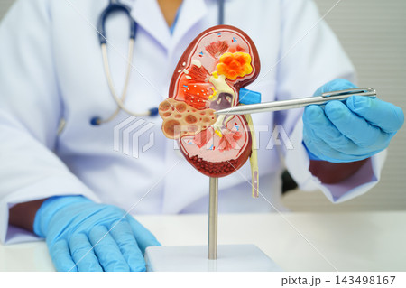 Chronic kidney disease, doctor with model for treatment urinary system, urology, Estimated glomerular filtration rate eGFR. Chronic kidney disease, doctor with model for treatment urinary system, urology, Estimated glomerular filtration rate eGFR. 143498167