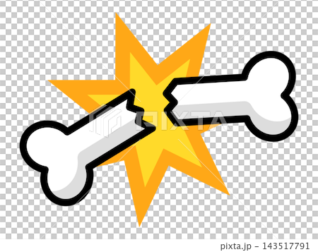 衝撃でポッキリと折れた骨の骨折イラスト 衝撃でポッキリと折れた骨の骨折イラスト 143517791