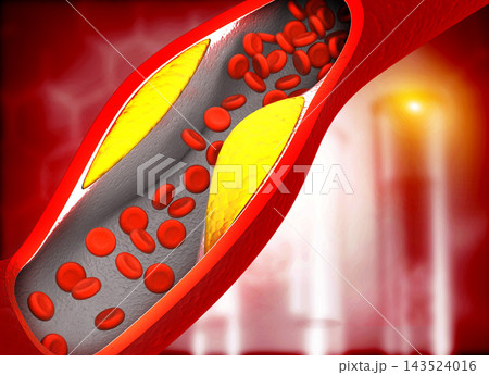Clogged arteries,Blocked blood vessel, artery with bad cholesterol Clogged arteries,Blocked blood vessel, artery with bad cholesterol 143524016