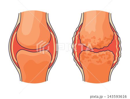 Rheumatoid arthritis. A comparison between a healthy knee and joint with Bone erosion, Cartilage wears, Reduced joint space and Swollen inflamed synovial membrane. Vector illustration 143593616