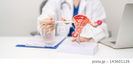 Doctor with Uterus and Ovaries anatomy model. Ovarian and Cervical cancer, Cervix disorder, Endometriosis, Hysterectomy, Uterine fibroids, Reproductive system, Pregnancy and health concept Doctor with Uterus and Ovaries anatomy model. Ovarian and Cervical cancer, Cervix disorder, Endometriosis, Hysterectomy, Uterine fibroids, Reproductive system, Pregnancy and health concept 143601126