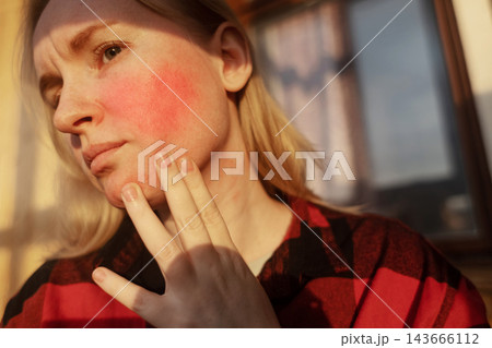 Woman experiencing facial flushing, facial redness, and rosacea symptoms on cheeks and forehead. Concept of erythrophobia, blushing syndrome, and skin allergy condition. 143666112