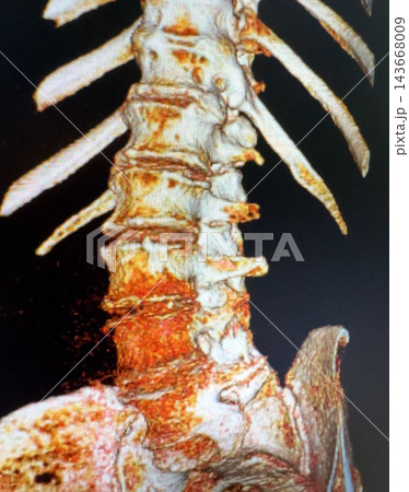 Three dimensional lumbar spine scan showing vertebrae and ribs in medical imaging view Three dimensional lumbar spine scan showing vertebrae and ribs in medical imaging view 143668009