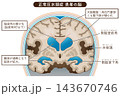 正常圧水頭症 Normal Pressure Hydrocephalus 143670746