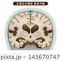 正常圧水頭症 Normal Pressure Hydrocephalus 143670747