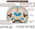 正常圧水頭症 Normal Pressure Hydrocephalus 143670748
