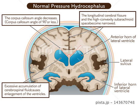 正常圧水頭症 Normal Pressure Hydrocephalus 143670748
