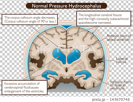 正常圧水頭症 Normal Pressure Hydrocephalus 143670748