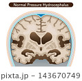 正常圧水頭症 Normal Pressure Hydrocephalus 143670749
