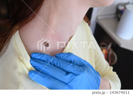 A woman examines a large mole on her neck. 143674011