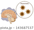 The Alzheimer's Brain: Amyloid-beta & Tau Protein 143687537
