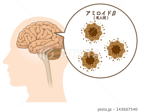 アルツハイマー病の脳 アミロイドβとタウたんぱく質 アルツハイマー病の脳 アミロイドβとタウたんぱく質 143687540