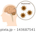 The Alzheimer's Brain: Amyloid-beta & Tau Protein 143687541
