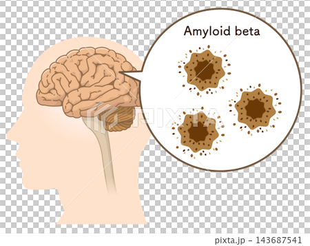The Alzheimer's Brain: Amyloid-beta & Tau Protein The Alzheimer's Brain: Amyloid-beta & Tau Protein 143687541